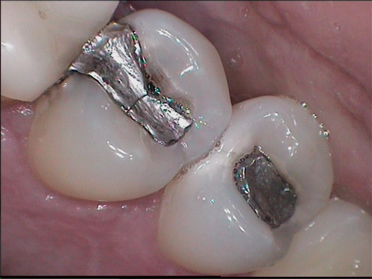 Two teeth silver fillings