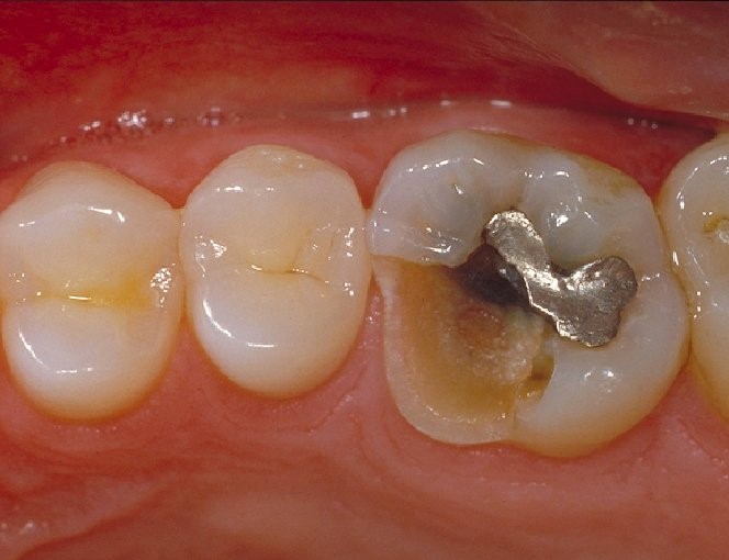 Tooth with over half of it's silver fillings broken off surround with healthy teeth